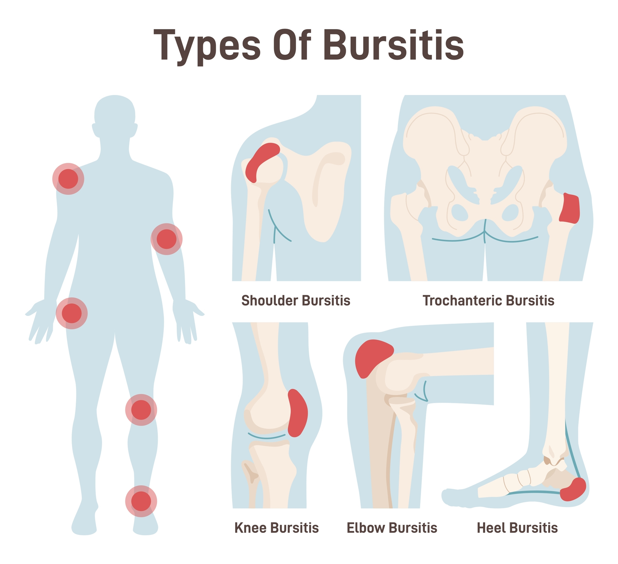 Diagram showing common types of bursitis, including shoulder, trochanteric, knee, elbow and heel