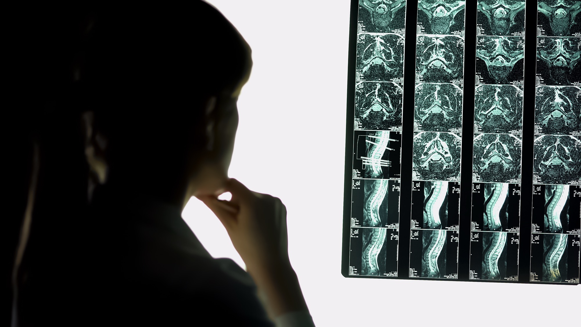 Clinician studying a panel of backlit spine MRI films